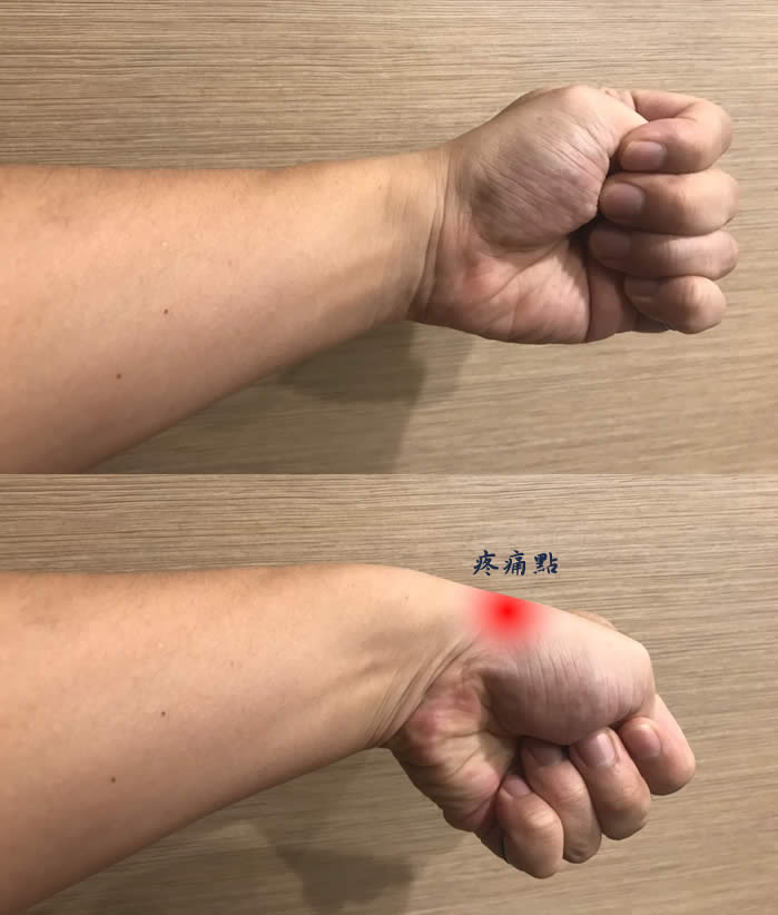擺脫媽媽手，日常保健不能少-何宜倫醫師